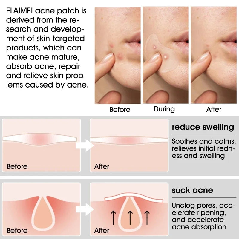 20 Patches Acne Patch Pimple Patches Blemish Protective Cover Absorbing Spot