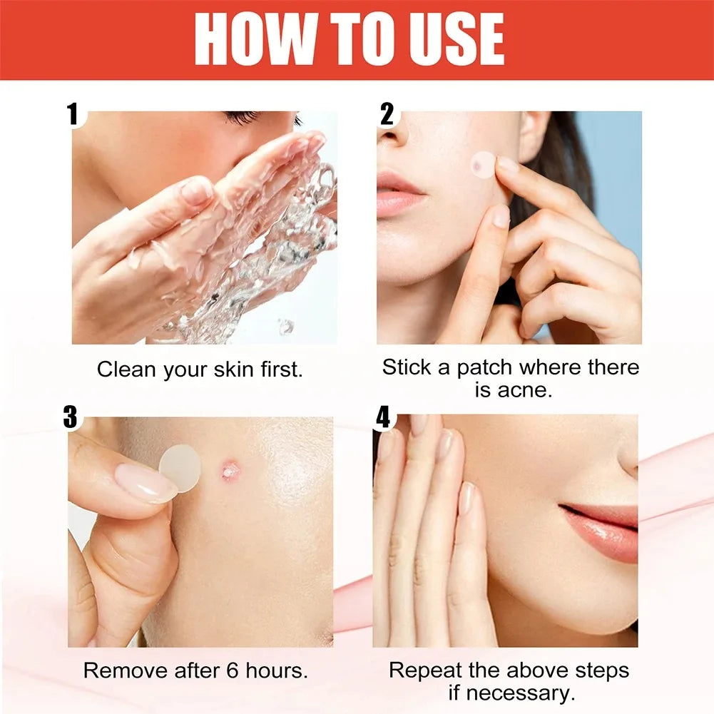240 adesivos antiacne em formato de coração/estrela/flor/redondo. Hidratantes e eficazes para cobrir espinhas e imperfeições.