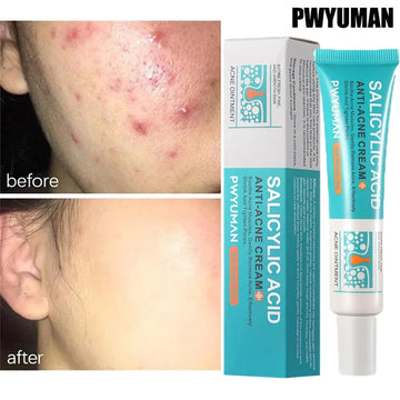 Salicylic Acid Acne Treatment Cream - Pore Shrinking, Oil Control & Brightening